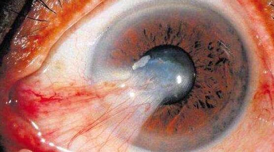 据烟台康爱眼科医院的眼病普查结果显示，当天共筛查149人， 大的94岁， 小的47岁。其中，24人因翼状胬肉急需手术医治，还有12人患有轻度翼状胬肉需随诊。1.jpg