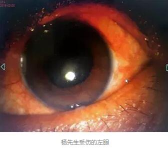 白内障和青光眼都是致盲性眼病，其中青光眼的病程不逆转。杨先生拖延伤情导致同时并发白内障、青光眼的情况，十分令人惋惜。”出名眼科专家、成都太阳成tyc122cc(中国)集团陈晓明教授表示2.jpg