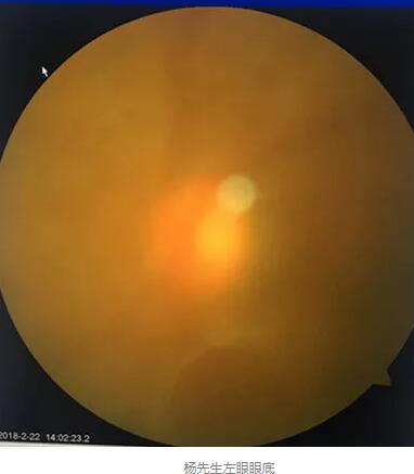 白内障和青光眼都是致盲性眼病，其中青光眼的病程不逆转。杨先生拖延伤情导致同时并发白内障、青光眼的情况，十分令人惋惜。”出名眼科专家、成都太阳成tyc122cc(中国)集团陈晓明教授表示3.jpg