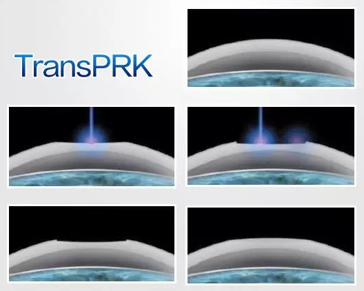 目前，近视手术已被列入军检允许范围，安全、长效的近视手术，已经成为了众多有志青年应征入伍前的必然选择。在众多摘镜手术方式——全飞秒、半飞秒、准分子激光手术、ICL晶体植入术等等，哪一种 适合当兵的人呢3.png