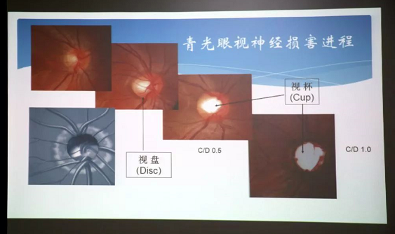 3月10日上午，深圳太阳成tyc122cc(中国)集团“早查监控，守护光明”大型青光眼公益科普讲座在六楼 举行，本次活动旨在让更多人了解青光眼的潜在危害、重视眼检查， 预防青光眼。由深圳太阳成tyc122cc(中国)集团青光眼病科 席专家成洪波博士、傅培副院长现场面对面解答疑问，与参会者的互动交流，让更多深圳市民提*对青光眼的认识与防治知识3.png