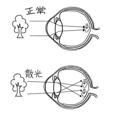 近视加散光想要 ，飞秒全激光近视手术是很好的选择。 一*次近视激光手术，就可以同时 近视、合并散光。1.jpg