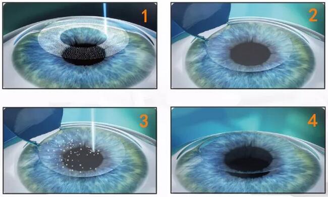 近视加散光想要 ，飞秒全激光近视手术是很好的选择。 一*次近视激光手术，就可以同时 近视、合并散光。2.jpg