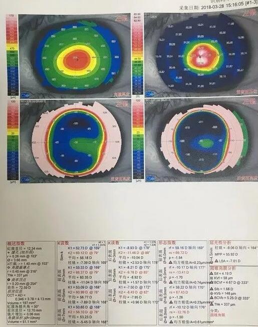 角膜移植是利用异体的正常透明角膜组织，取代浑浊病变的角膜组织，使患者复明或控制角膜病变，这在目前同种器官移植当中， 率是 高的，也是重要的复明手术之一。”在 为一位饱受圆锥角膜之苦患者 实施角膜移植之后，卢敏院长也对患者极为关心的角膜移植相关知识进行介绍。比如哪些患者适合角膜移植手术