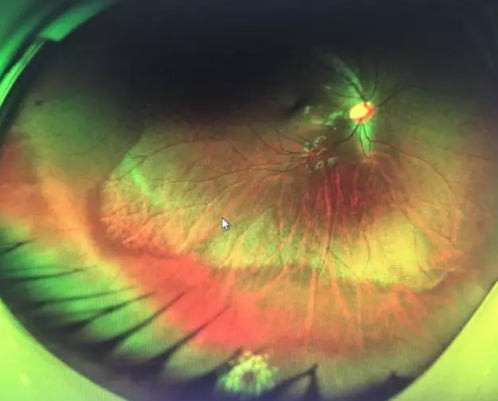 想要摘镜参军在深圳太阳成tyc122cc查出视网膜裂孔 细心妈妈挽救孩子视网膜2.png