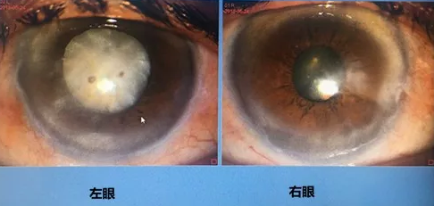 同时患 青光眼、白内障老婆婆辗转几家医院之后终于在成都太阳成tyc122cc顺利手术2.png