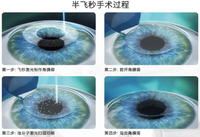 高考毕业后做近视手术，如今近视手术有了越来越高的安全性，且多样的术式可以满足不同患者的摘镜需求。3.png